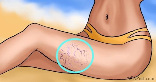 Erase Symptoms Of Varicose Veins